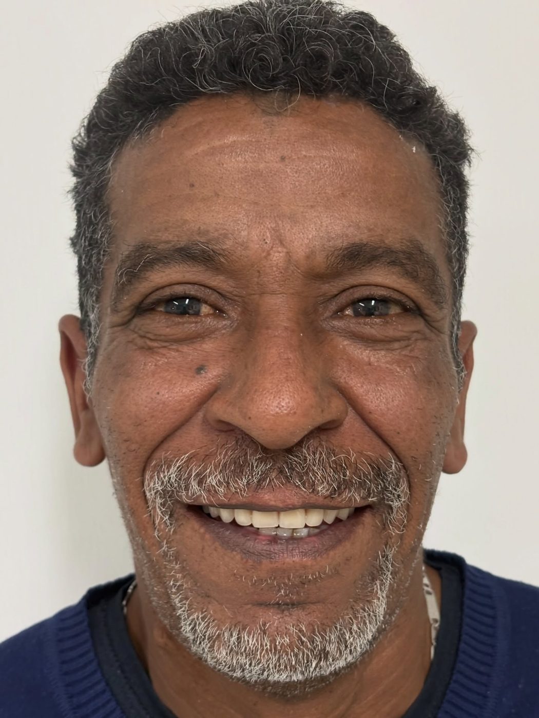 Paciente sorrindo com a prótese nova